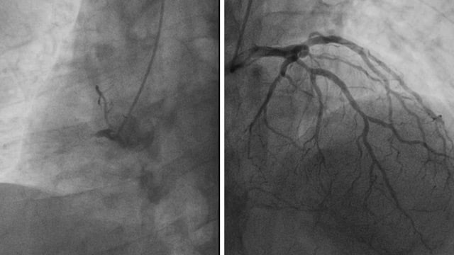 Intracoronary imaging in daily practice: cases where OCT did help... a lot!