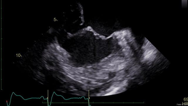 Introduction to the PCR London Valves 2019 Mitral and Tricuspid track - The key questions in mitral and tricuspid valve interventions: where are we in 2019?