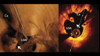 Isolated side branch stenosis: how should I treat?