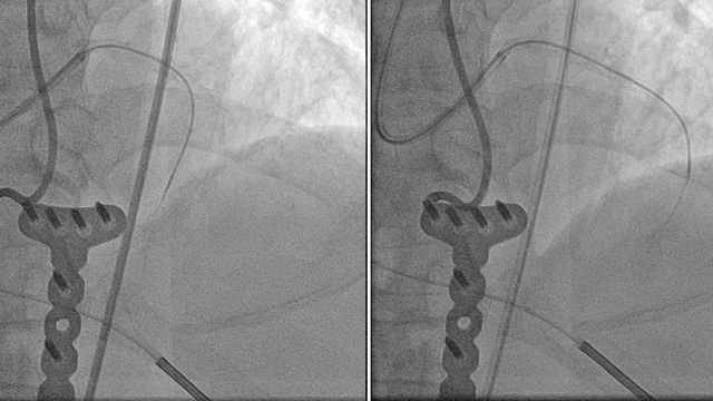 Latest clinical and technology update of Firehawk Target eluting stent platform