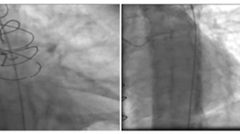 Learning to expect the unexpected: practical lessons from treating patients with STEMI