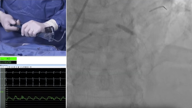 Left main and complex bifurcations stenting