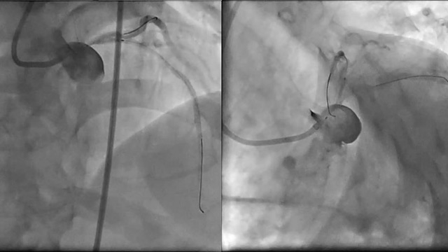 Left main bifurcation complicated cases: when planning and patience are paramount
