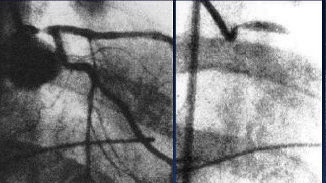Left main revascularization: what you should know