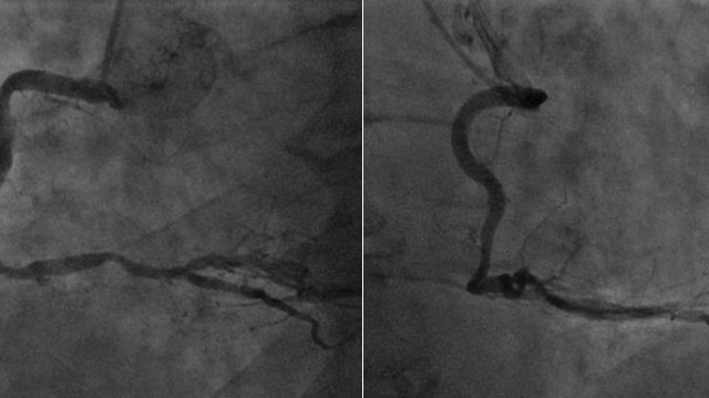 Imaging and physiology for left main PCI