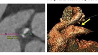 Major TAVI complication (annulus rupture, valve embolisation, incomplete frame expansion)