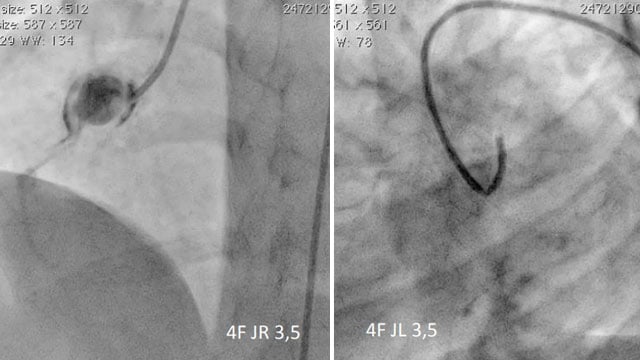 Management of coronary aneurysms - Part 1