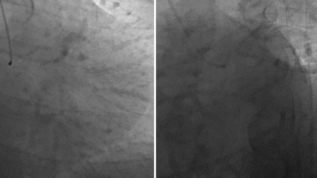 Management of coronary perforations - Part 2
