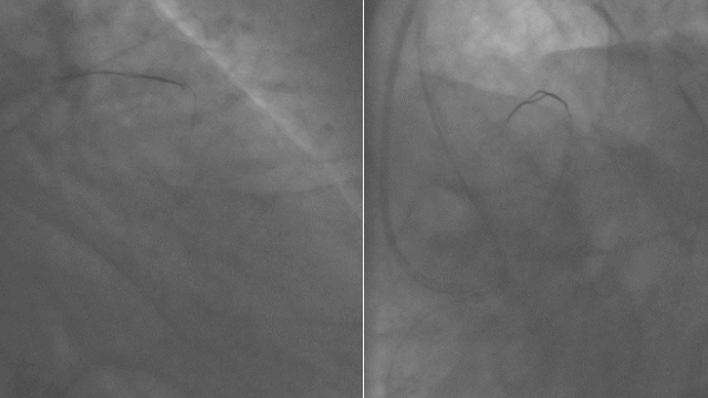 Managing calcified lesion: a never ending challenge