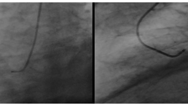 Mechanical circulatory support in cardiogenic shock