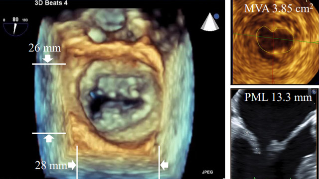 MitraClip imaging-based patient selection