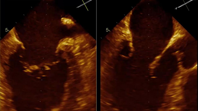 MitraClip - Recorded case from Clinique Pasteur - Toulouse, France