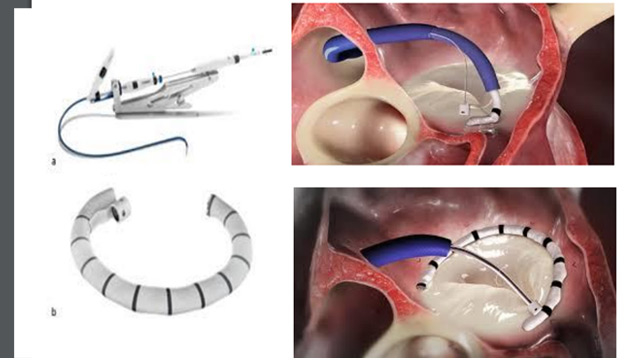 Mitral insufficiency repair treated with new technologies