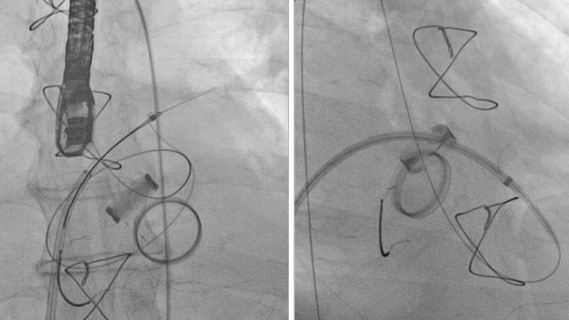 Mitral paravalvular leak: the best and the ugly