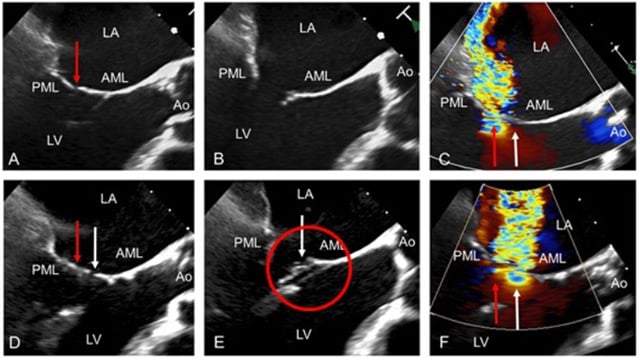 Mitral valve repair and replacement registries