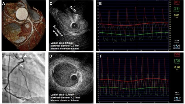 New approaches in the functional assessment of coronary stenosis