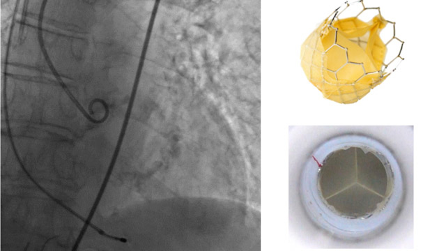 Novel transcatheter prostheses for TAVI