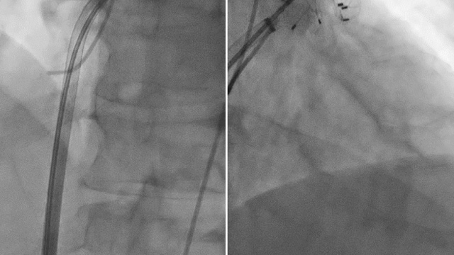 Novel transcatheter solutions in unusual clinical scenarios