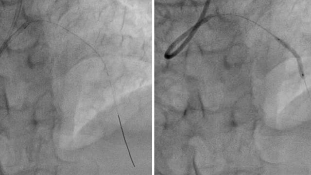 Novelties in treatment of complex ACS and STEMI patients