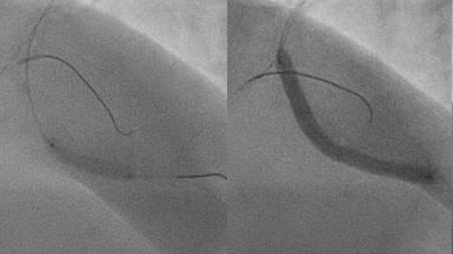 Optimising the treatment of severely calcified vessels with orbital atherectomy