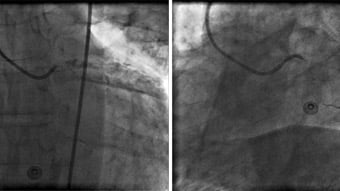 PCI complications in acute STEMI