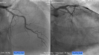 PCI in cardiogenic shock: learning from real-life cases