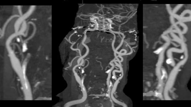 Peripheral intervention