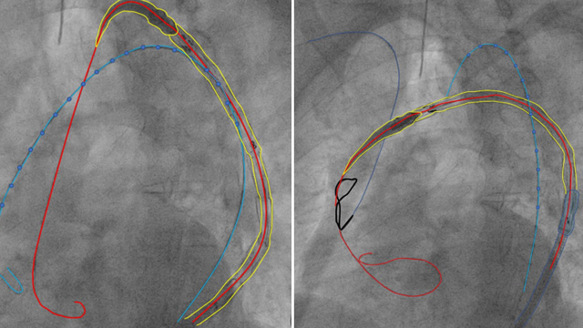 Peripheral intervention