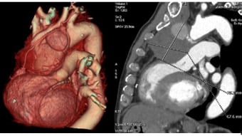 Peripheral interventions complications session