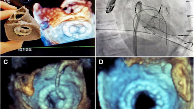 Planning mitral procedures: adding the third dimension