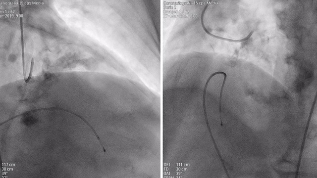 Precision meets simplicity – Complex PCI guided by a 2nd generation fibre optic physiology guidewire