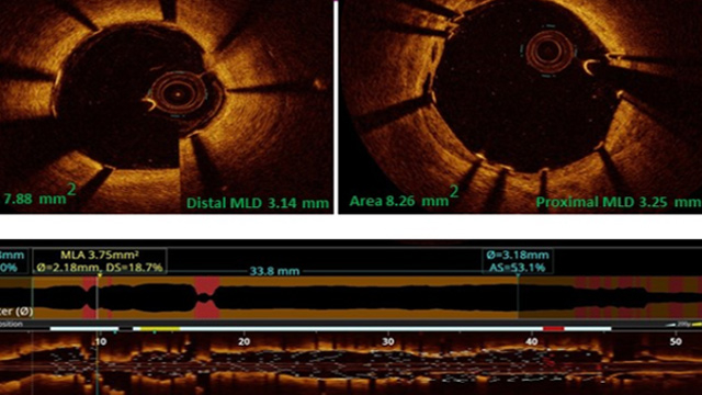 Precision PCI - Role of imaging and physiology in optimisation of PCI