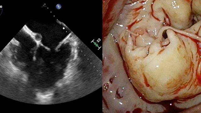Primary mitral regurgitation in 2019: how to deliver the best treatment to our patients