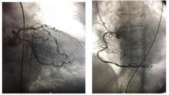 #radialfirst: cases, complications and more