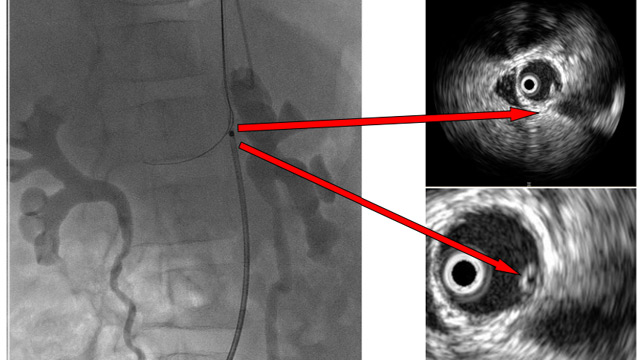 Renal interventions for hypertension
