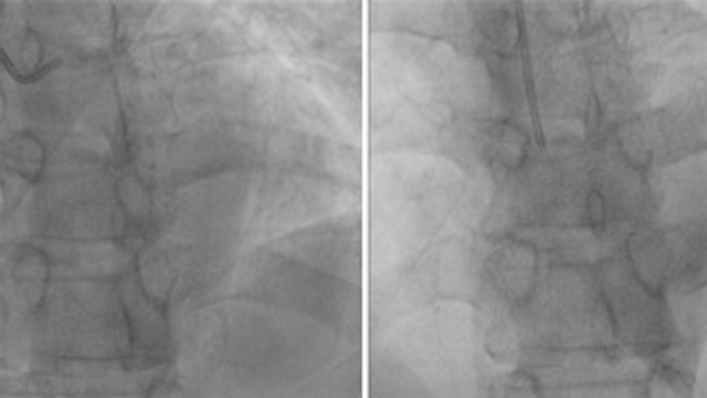 Rotational atherectomy for the treatment of calcified CTO