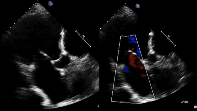 Safety and effectiveness of transcatheter mitral leaflet approximation with MitraClip