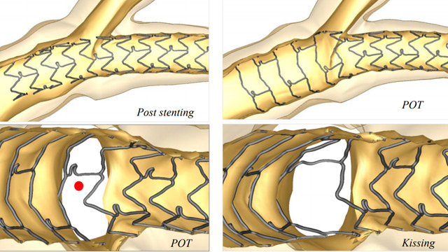 Side branch management in provisional bifurcation stenting