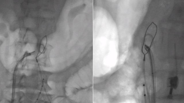 Special procedures: transcaval access