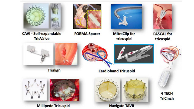 Spotlight - Challenges for the Heart Team I - A new interventional paradigm for aortic valve disease