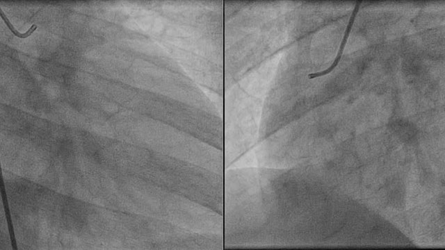 STEMI in young men: all but easy to treat