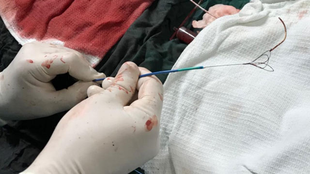 Stent dislodgement still happens! - Part 1