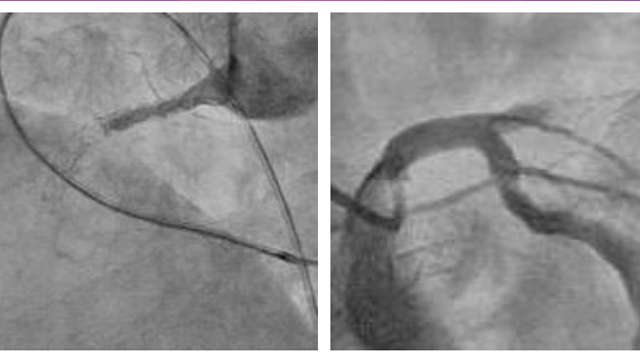 Stent thrombosis: what's next?