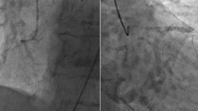 Strategies for the treatment of calcified coronary artery lesions