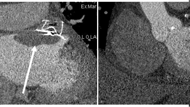 Structural interventions: thrombus horribilis!