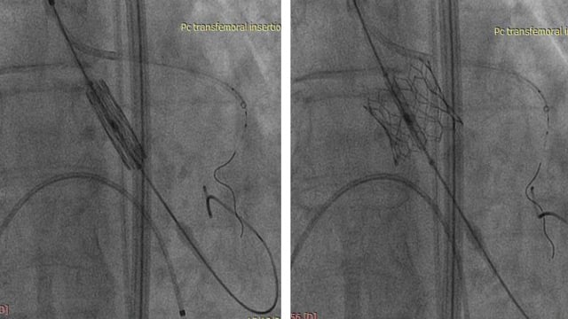 TAVI and coronary artery disease