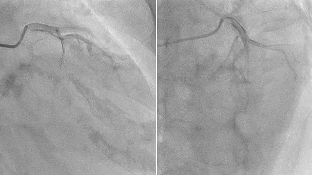 TAVI and mitral interventions