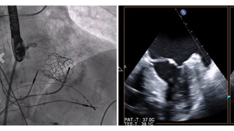TAVI and stroke prevention