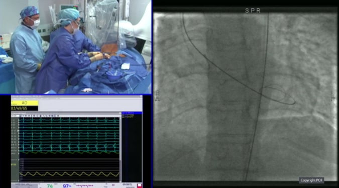 TAVI in a type 0 bicuspid aortic valve with low lying LM