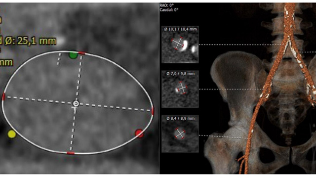 TAVI in unusual clinical situations